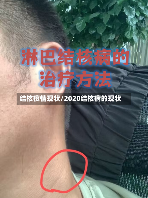 结核疫情现状/2020结核病的现状-第2张图片